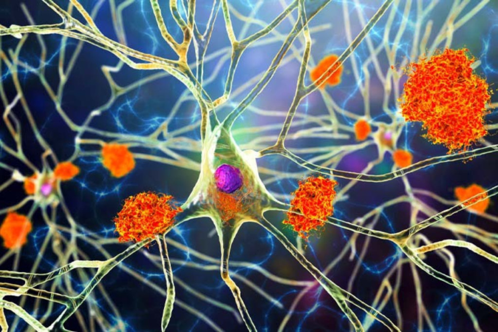 Leitura e alzheimer.