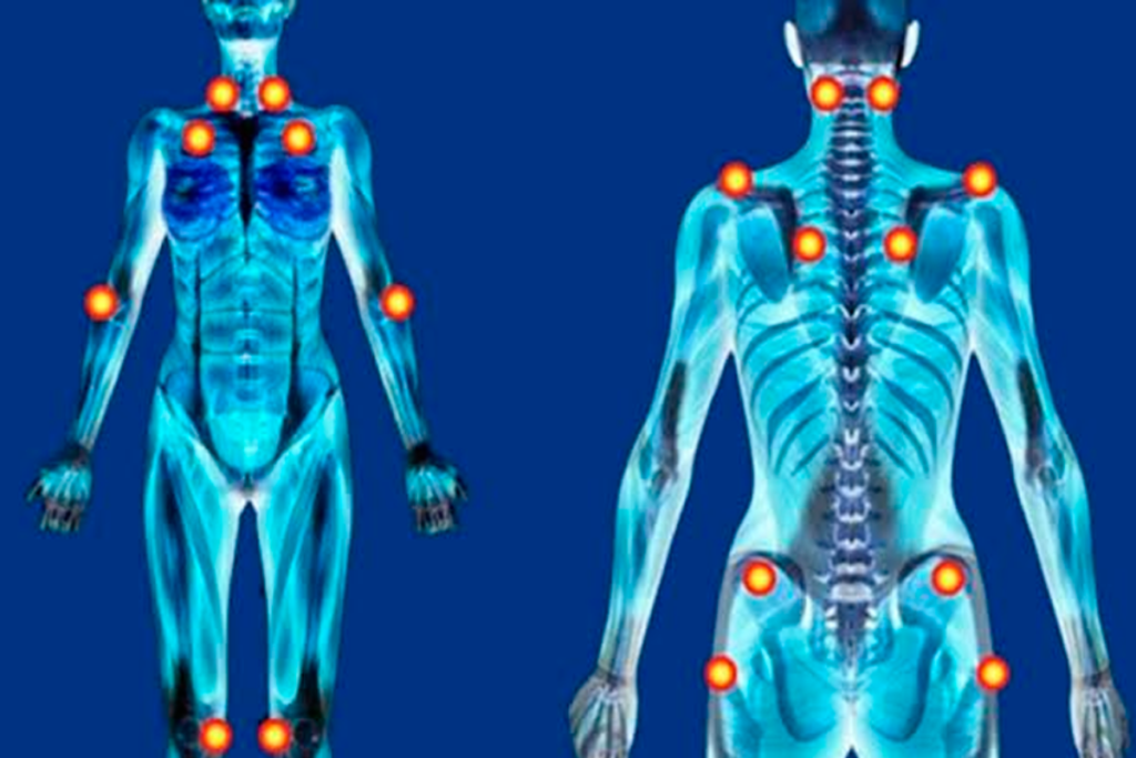 Fibromialgia e dores .
