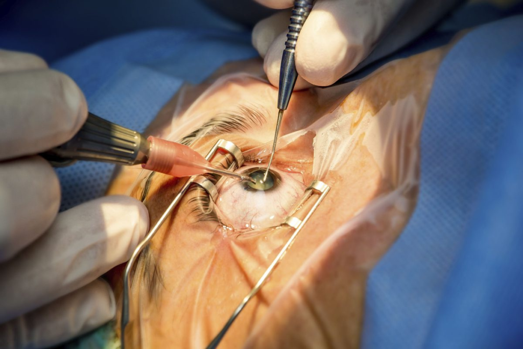 Cirurgia de catarata.